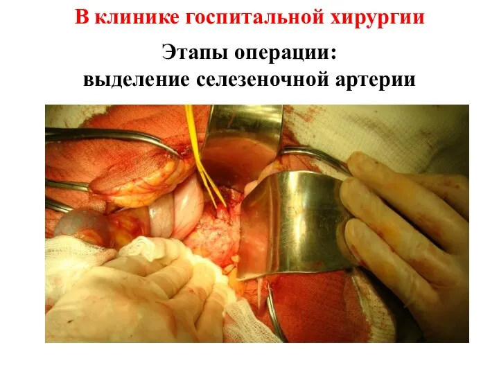 Этапы операции: выделение селезеночной артерии В клинике госпитальной хирургии