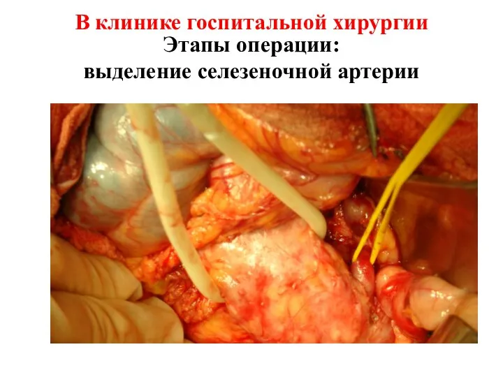 В клинике госпитальной хирургии Этапы операции: выделение селезеночной артерии