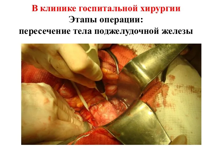 В клинике госпитальной хирургии Этапы операции: пересечение тела поджелудочной железы