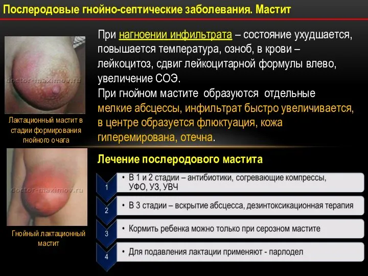 Послеродовые гнойно-септические заболевания. Мастит При нагноении инфильтрата – состояние ухудшается, повышается температура,