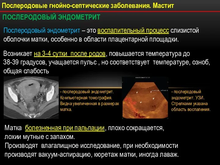 Послеродовые гнойно-септические заболевания. Мастит ПОСЛЕРОДОВЫЙ ЭНДОМЕТРИТ Послеродовый эндометрит – это воспалительный процесс