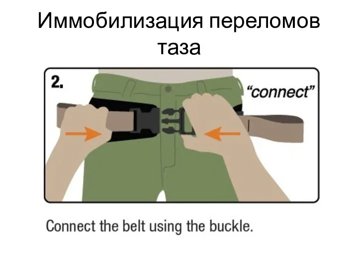 Иммобилизация переломов таза