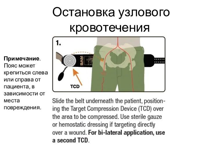 Остановка узлового кровотечения Примечание. Пояс может крепиться слева или справа от пациента,