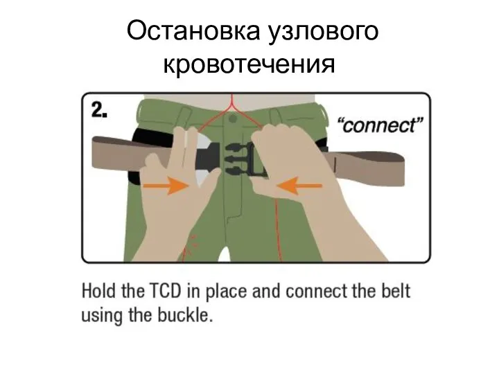 Остановка узлового кровотечения