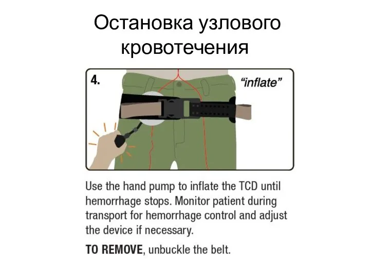 Остановка узлового кровотечения