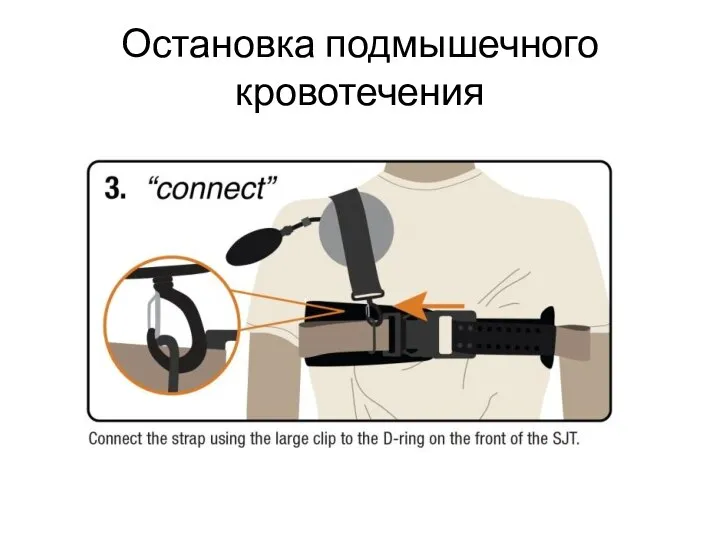 Остановка подмышечного кровотечения