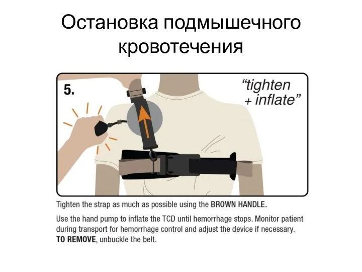 Остановка подмышечного кровотечения