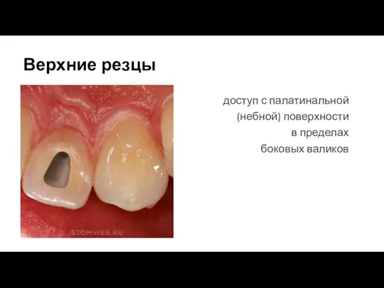 Верхние резцы доступ с палатинальной (небной) поверхности в пределах боковых валиков