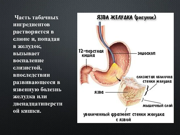 Часть табачных ингредиентов растворяется в слюне и, попадая в желудок, вызывает воспаление