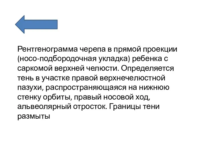 Рентгенограмма черепа в прямой проекции (носо-подбородочная укладка) ребенка с саркомой верхней челюсти.