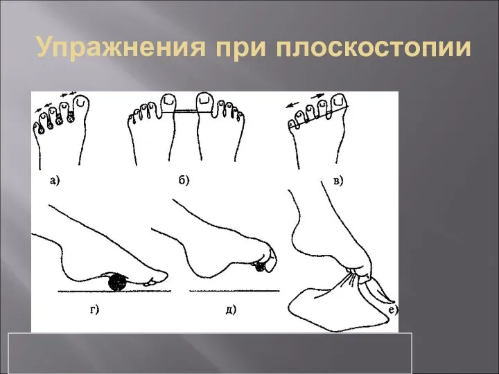 Упражнения при плоскостопии