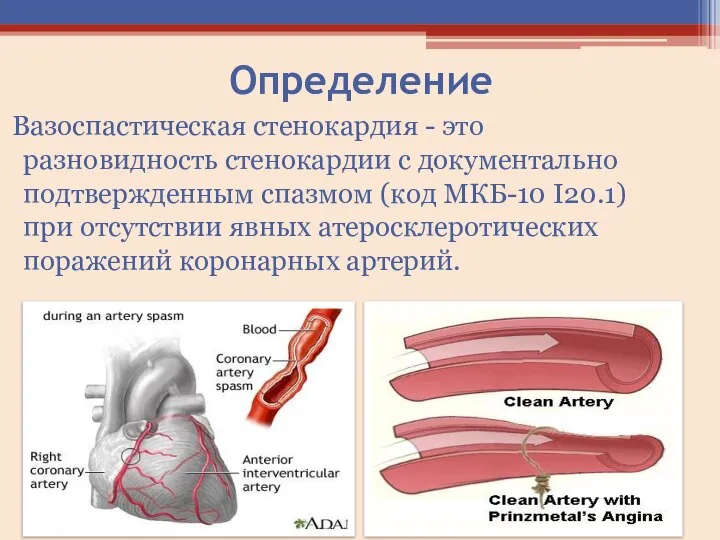 Определение Вазоспастическая стенокардия - это разновидность стенокардии с документально подтвержденным спазмом (код