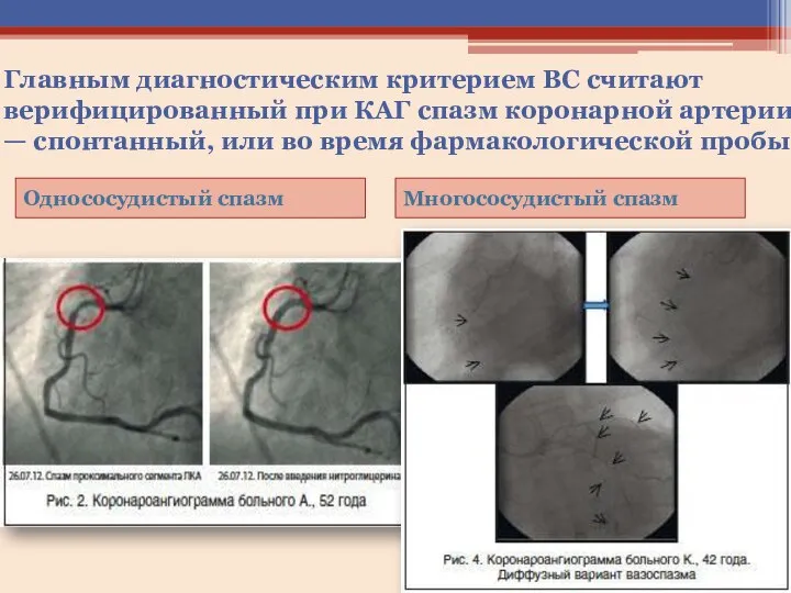 Главным диагностическим критерием ВС считают верифицированный при КАГ спазм коронарной артерии —