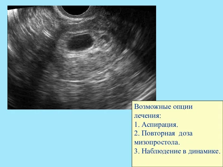 Возможные опции лечения: 1. Аспирация. 2. Повторная доза мизопростола. 3. Наблюдение в динамике.