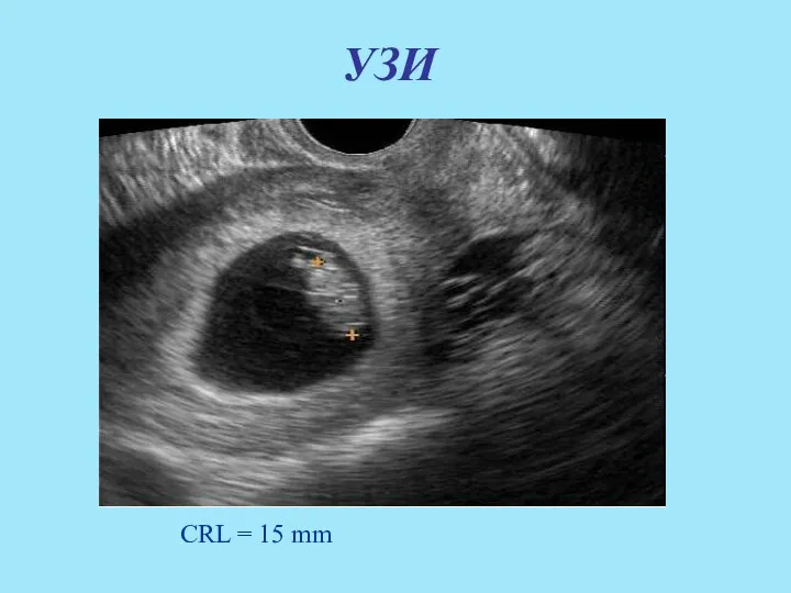 УЗИ CRL = 15 mm