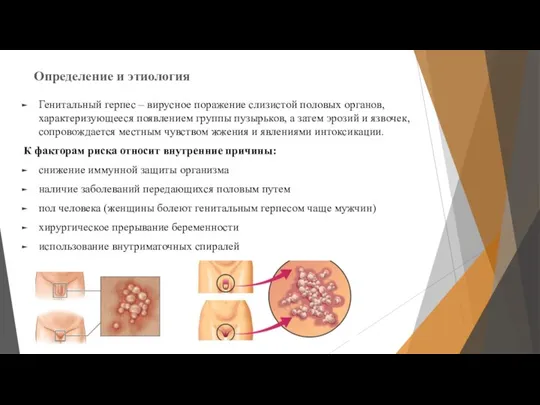 Определение и этиология Генитальный герпес – вирусное поражение слизистой половых органов, характеризующееся