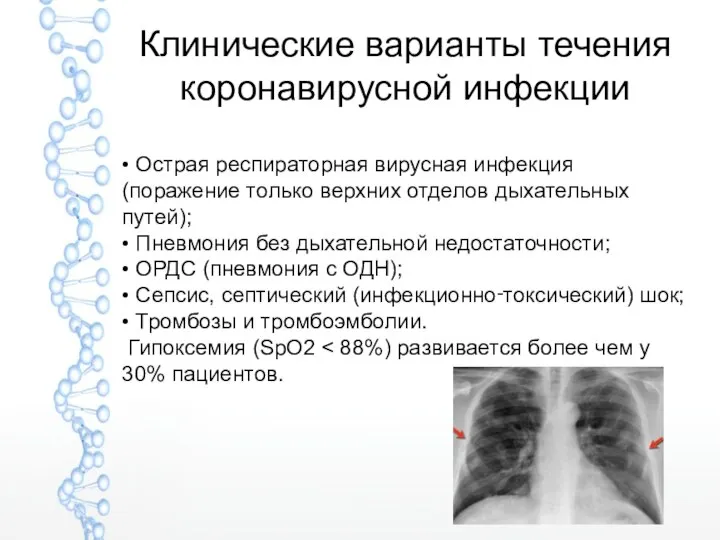 Клинические варианты течения коронавирусной инфекции • Острая респираторная вирусная инфекция (поражение только