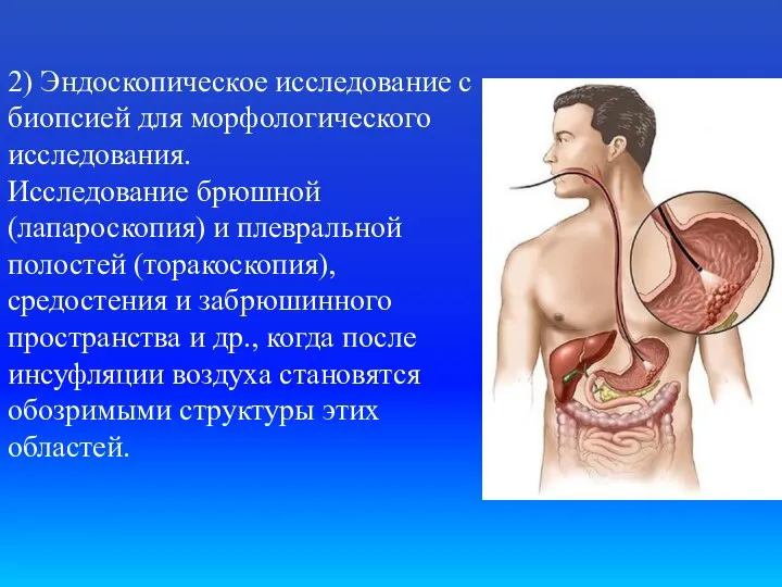 2) Эндоскопическое исследование с биопсией для морфологического исследования. Исследование брюшной (лапароскопия) и