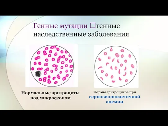 Генные мутации ?генные наследственные заболевания Нормальные эритроциты под микроскопом Формы эритроцитов при серповидноклеточной анемии