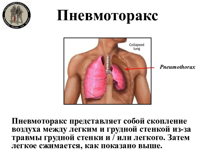 Пневмоторакс Пневмоторакс представляет собой скопление воздуха между легким и грудной стенкой из-за