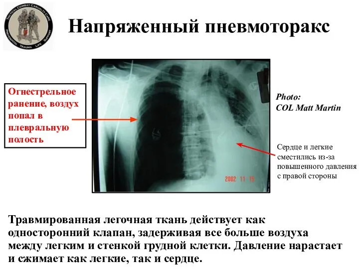 Огнестрельное ранение, воздух попал в плевральную полость Травмированная легочная ткань действует как