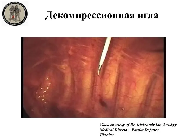 Декомпрессионная игла Video courtesy of Dr. Oleksandr Linchevskyy Medical Director, Patriot Defence Ukraine