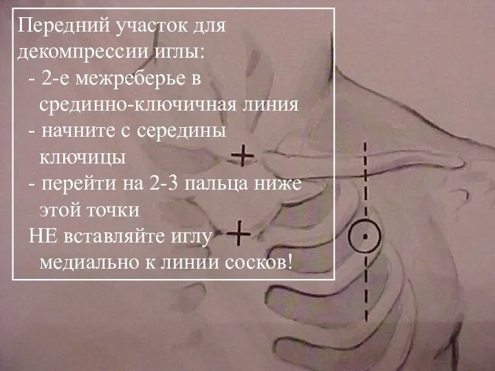 Picture of general location for needle insertion Передний участок для декомпрессии иглы: