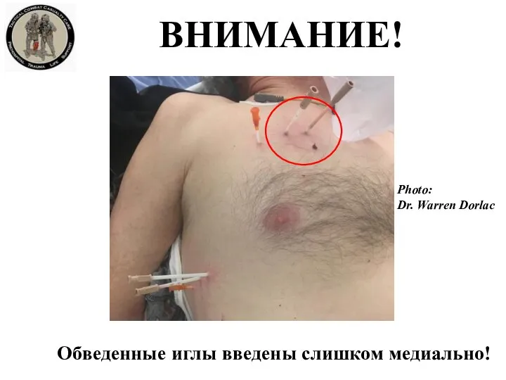 ВНИМАНИЕ! Обведенные иглы введены слишком медиально! Photo: Dr. Warren Dorlac