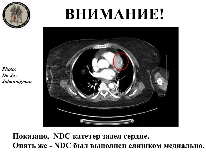 ВНИМАНИЕ! Показано, NDC катетер задел сердце. Опять же - NDC был выполнен