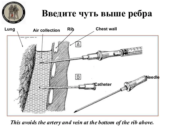 Введите чуть выше ребра Chest wall Rib Air collection Lung Catheter Needle