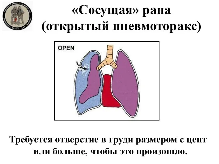 «Сосущая» рана (открытый пневмоторакс) Требуется отверстие в груди размером с цент или больше, чтобы это произошло.