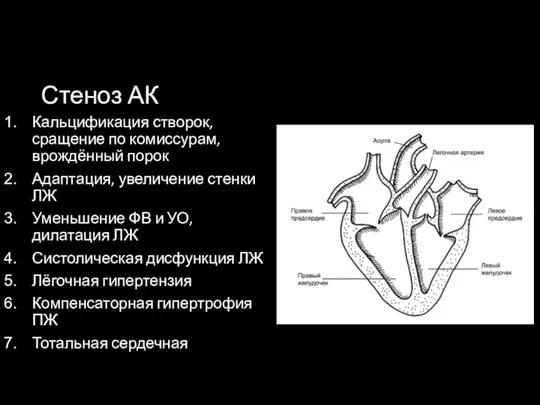 Стеноз АК Кальцификация створок, сращение по комиссурам, врождённый порок Адаптация, увеличение стенки