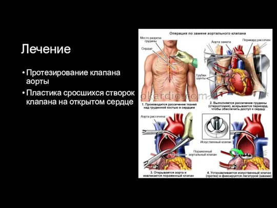 Лечение Протезирование клапана аорты Пластика сросшихся створок клапана на открытом сердце