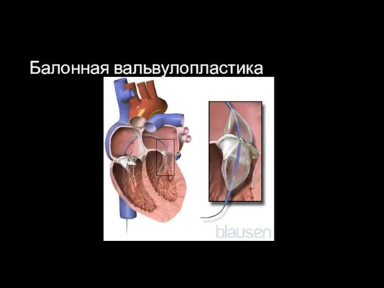 Балонная вальвулопластика