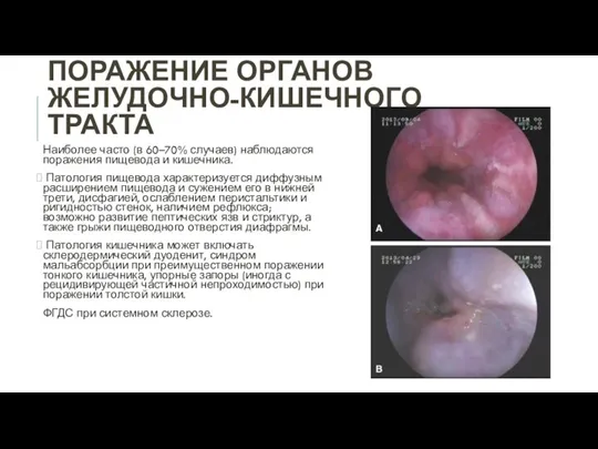 ПОРАЖЕНИЕ ОРГАНОВ ЖЕЛУДОЧНО-КИШЕЧНОГО ТРАКТА Наиболее часто (в 60–70% случаев) наблюдаются поражения пищевода