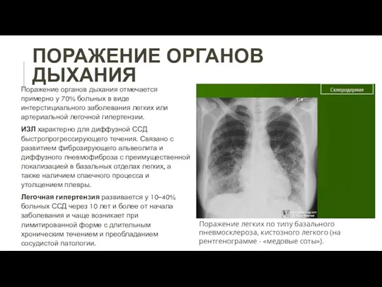 ПОРАЖЕНИЕ ОРГАНОВ ДЫХАНИЯ Поражение легких по типу базального пневмосклероза, кистозного легкого (на