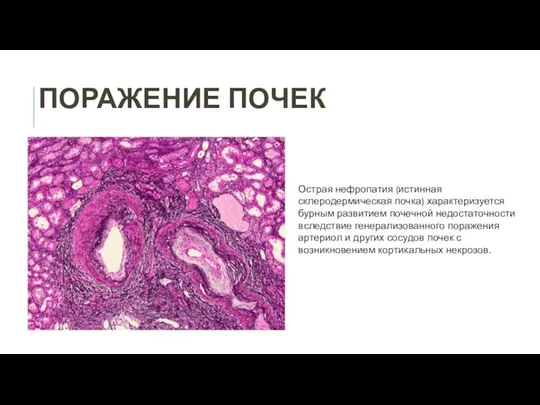 ПОРАЖЕНИЕ ПОЧЕК Острая нефропатия (истинная склеродермическая почка) характеризуется бурным развитием почечной недостаточности