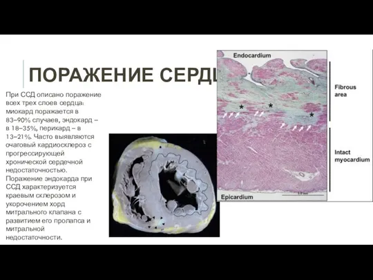 ПОРАЖЕНИЕ СЕРДЦА При ССД описано поражение всех трех слоев сердца: миокард поражается