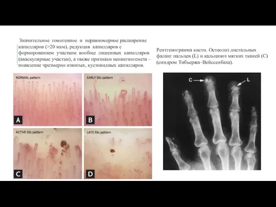 Рентгенограмма кисти. Остеолиз дистальных фаланг пальцев (L) и кальциноз мягких тканей (C)