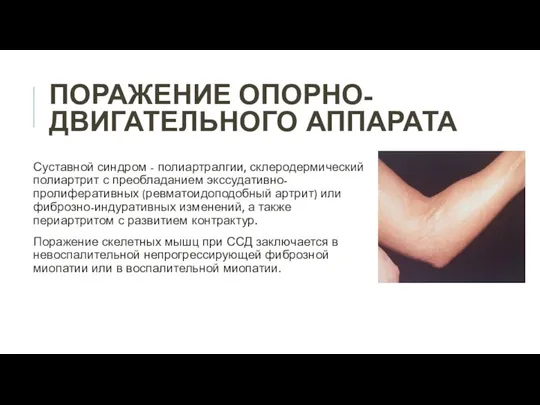 ПОРАЖЕНИЕ ОПОРНО-ДВИГАТЕЛЬНОГО АППАРАТА Суставной синдром - полиартралгии, склеродермический полиартрит с преобладанием экссудативно-пролиферативных