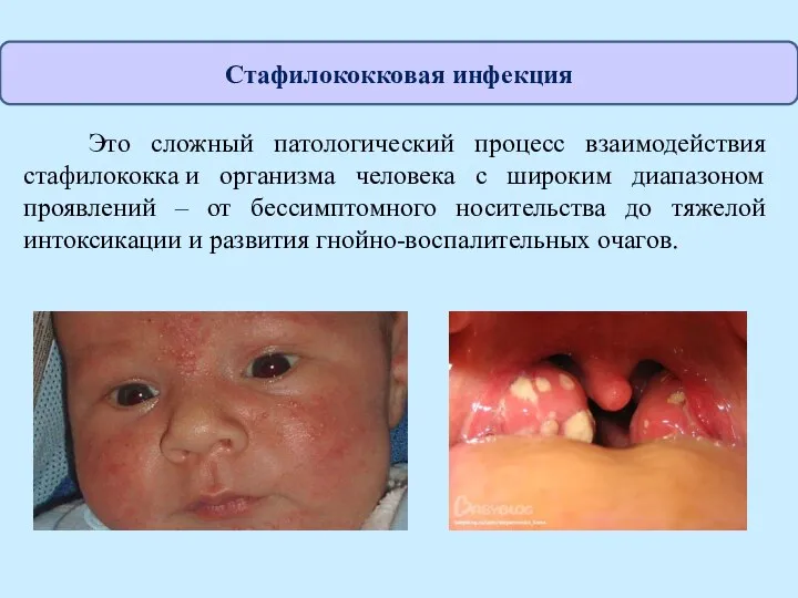 Это сложный патологический процесс взаимодействия стафилококка и организма человека с широким диапазоном