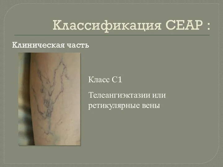 Классификация СЕАР : Клиническая часть Класс С1 Телеангиэктазии или ретикулярные вены