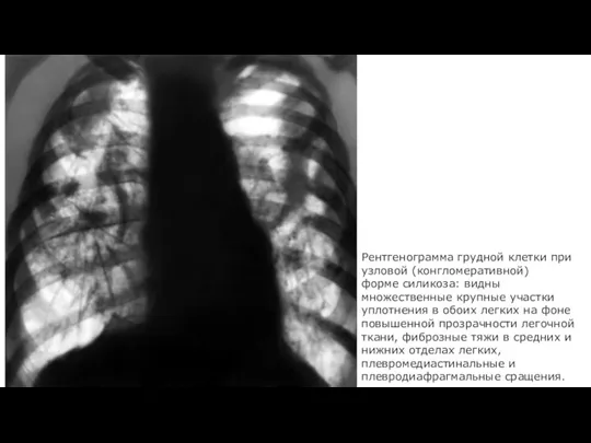 Рентгенограмма грудной клетки при узловой (конгломеративной) форме силикоза: видны множественные крупные участки
