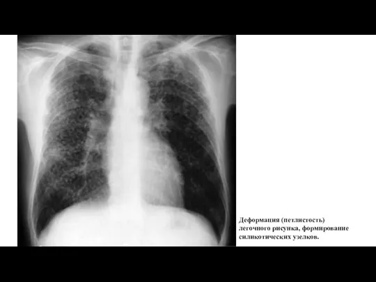 Деформация (петлистость) легочного рисунка, формирование силикотических узелков.
