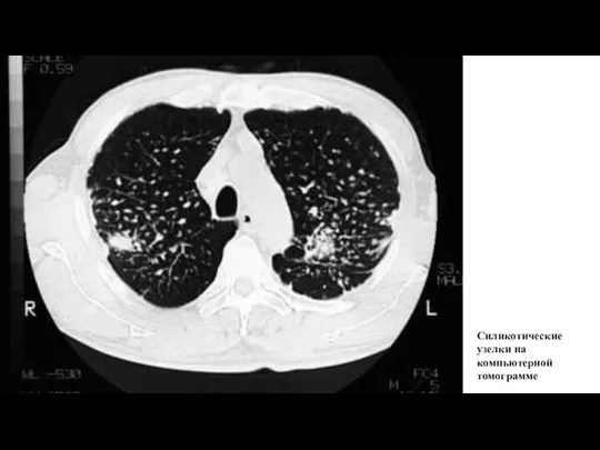 Силикотические узелки на компьютерной томограмме
