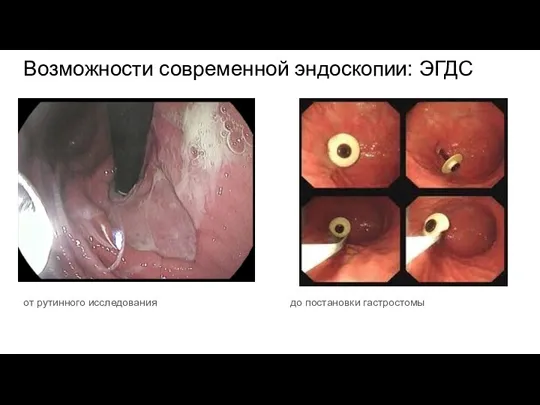 Возможности современной эндоскопии: ЭГДС от рутинного исследования до постановки гастростомы