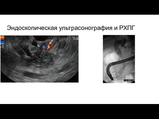 Эндоскопическая ультрасонография и РХПГ