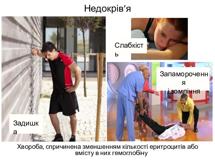 Недокрів’я Хвороба, спричинена зменшенням кількості еритроцитів або вмісту в них гемоглобіну Задишка Слабкість Запаморочення і зомління