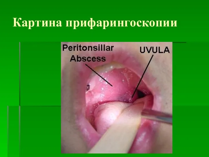 Картина прифарингоскопии