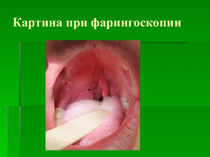 Картина при фарингоскопии